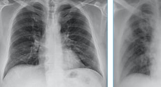 COVID-19 Chest X-Ray